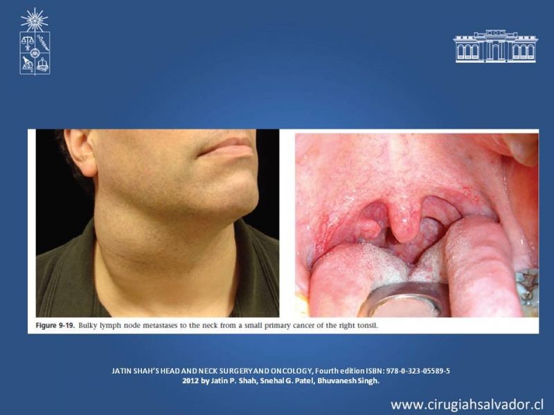 Diapositiva 7 de Cáncer de amígdala (Tonsila palatina)