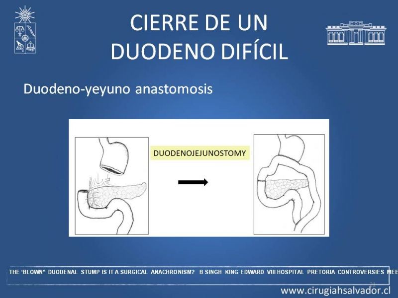 Diapositiva 20 de Manejo del muñón duodenal difícil