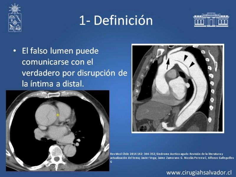 Diapositiva 5 de Síndrome Aórtico Agudo