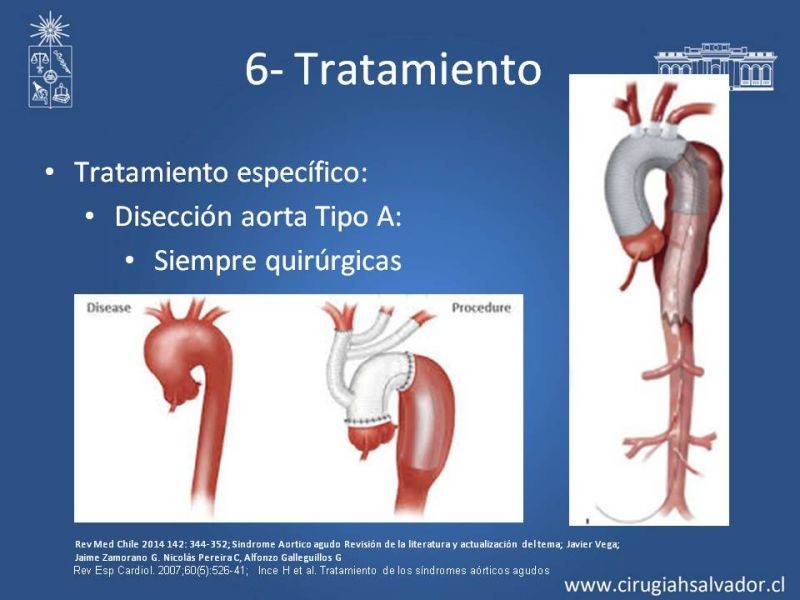 Diapositiva 30 de Síndrome Aórtico Agudo