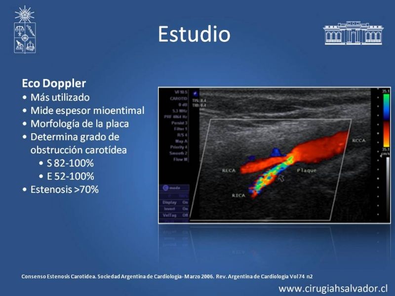 Diapositiva 12 de Estenosis Carotídea Asintomática