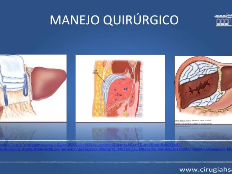 Diapositiva 20 de Trauma hepático
