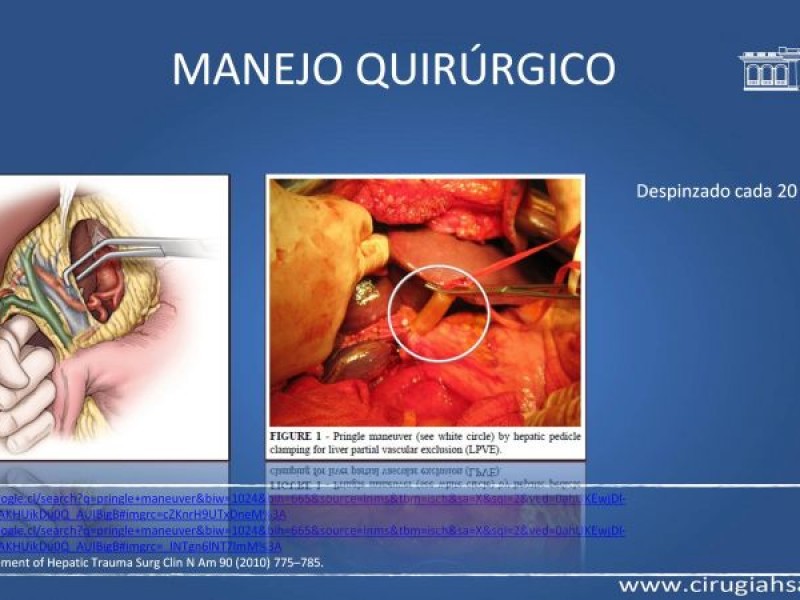 Diapositiva 19 de Trauma hepático