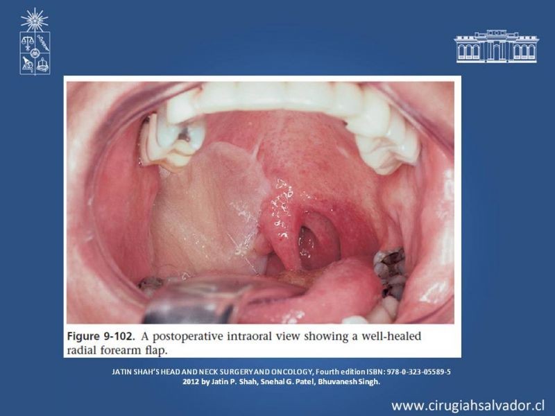 Diapositiva 14 de Cáncer de amígdala (Tonsila palatina)