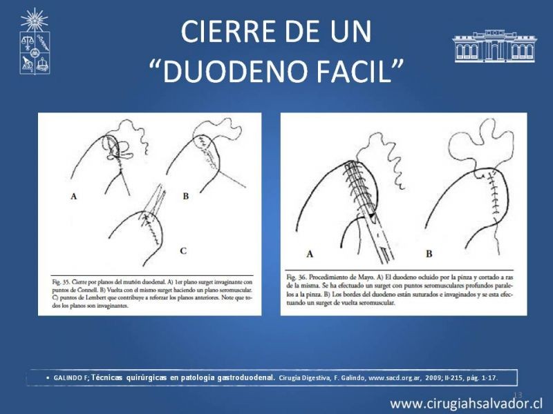 Diapositiva 12 de Manejo del muñón duodenal difícil