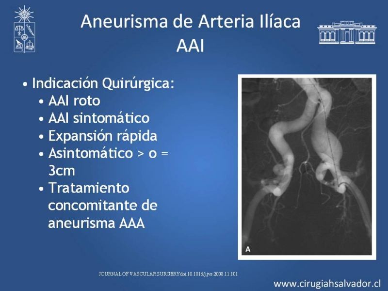 Diapositiva 19 de Aneurismas Periféricos