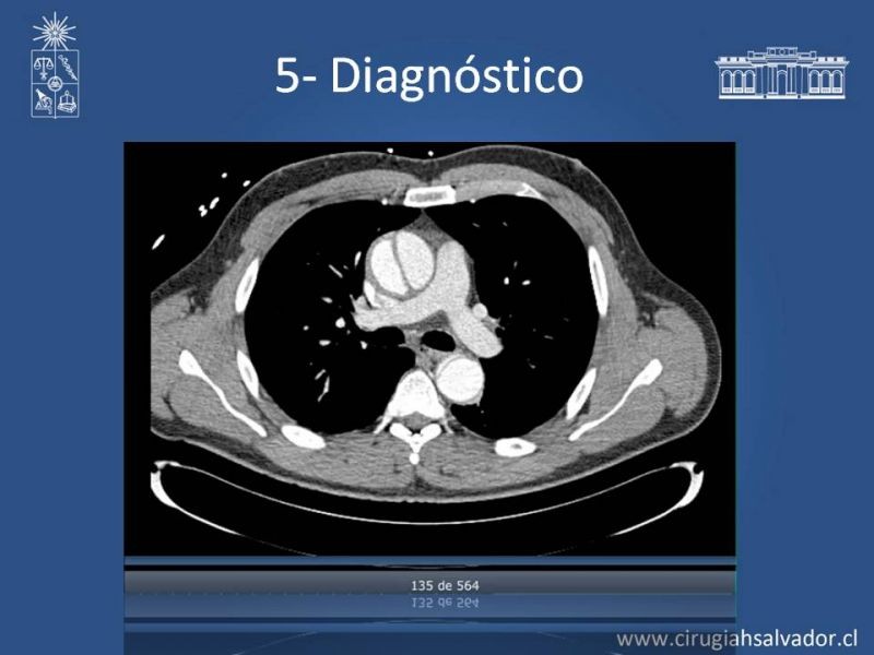 Diapositiva 27 de Síndrome Aórtico Agudo