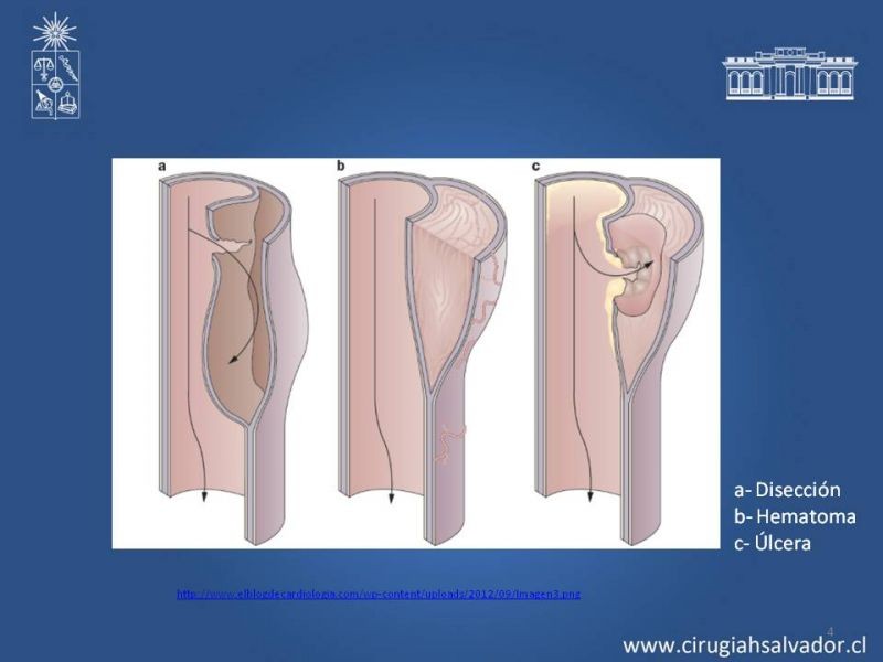 Diapositiva 3 de Síndrome Aórtico Agudo