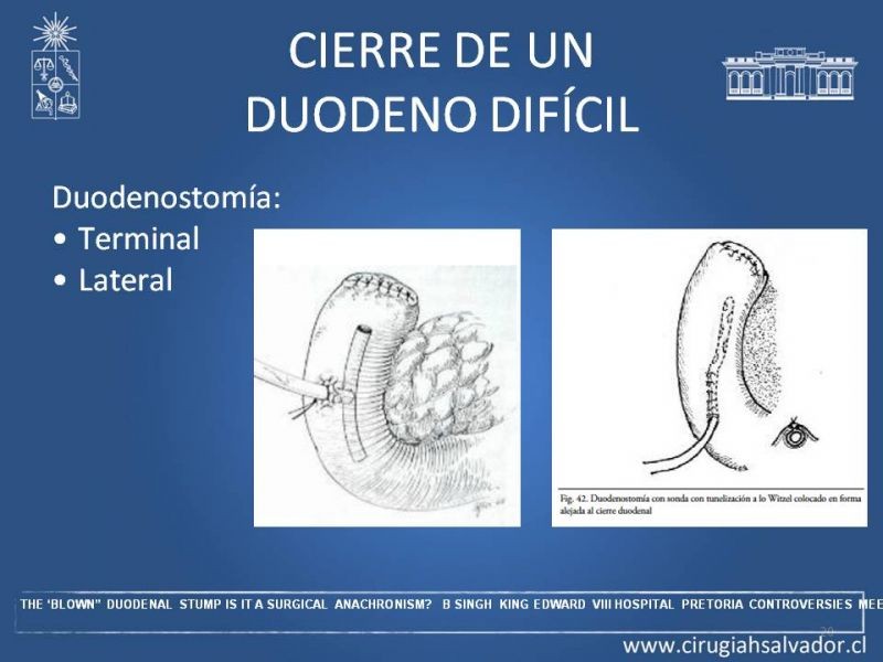 Diapositiva 19 de Manejo del muñón duodenal difícil