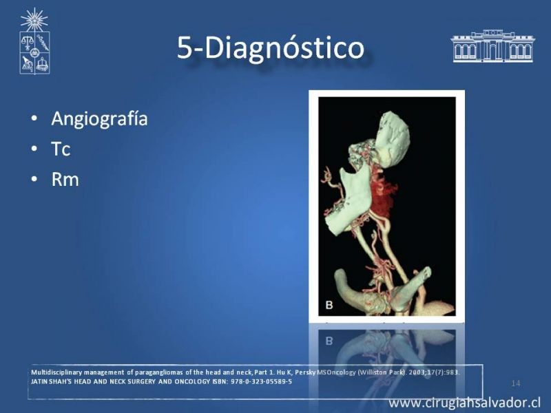 Diapositiva 13 de Paraganglioma cervical