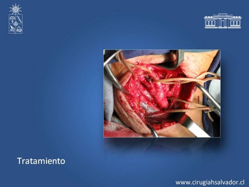 Diapositiva 19 de Estenosis Carotídea Asintomática