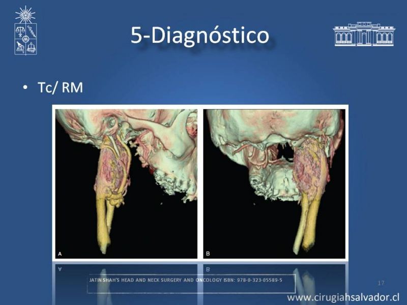 Diapositiva 16 de Paraganglioma cervical