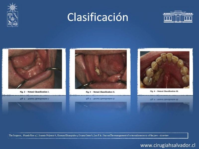 Diapositiva 12 de Osteoradionecrosis