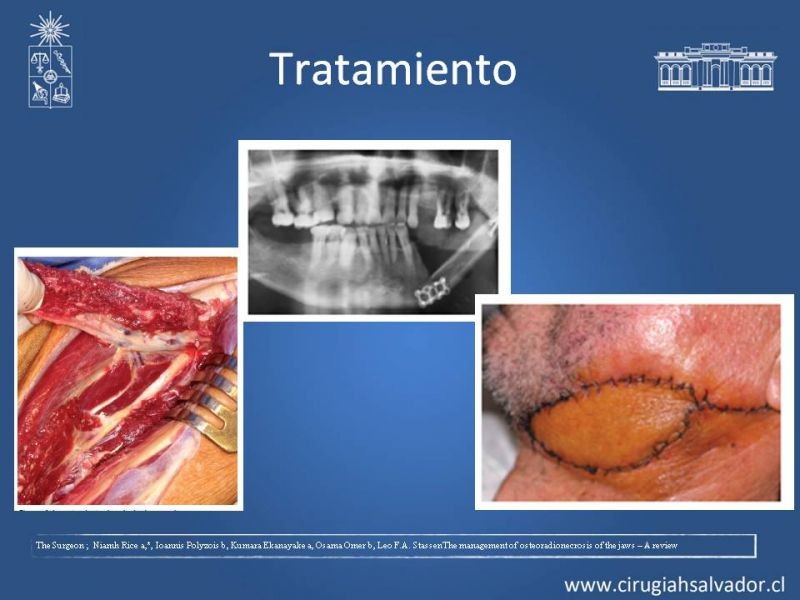 Diapositiva 16 de Osteoradionecrosis