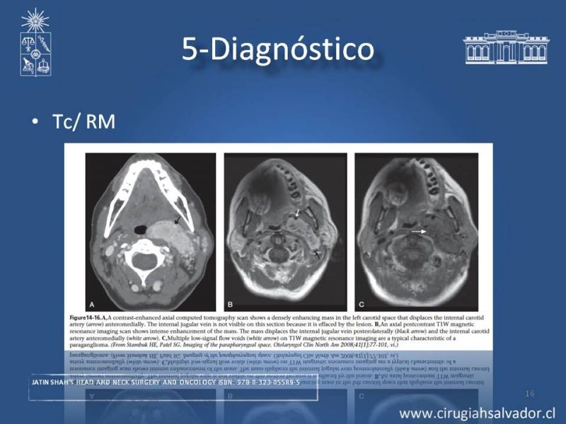 Diapositiva 15 de Paraganglioma cervical