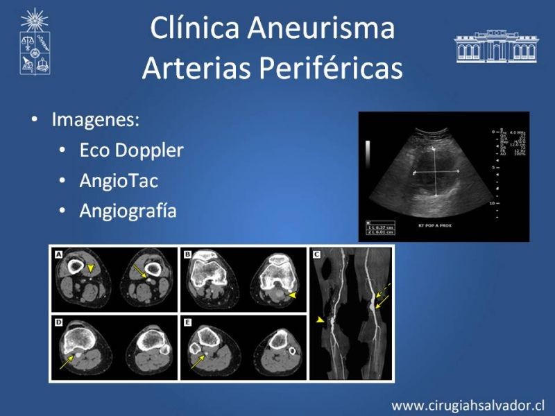 Diapositiva 17 de Aneurismas Periféricos