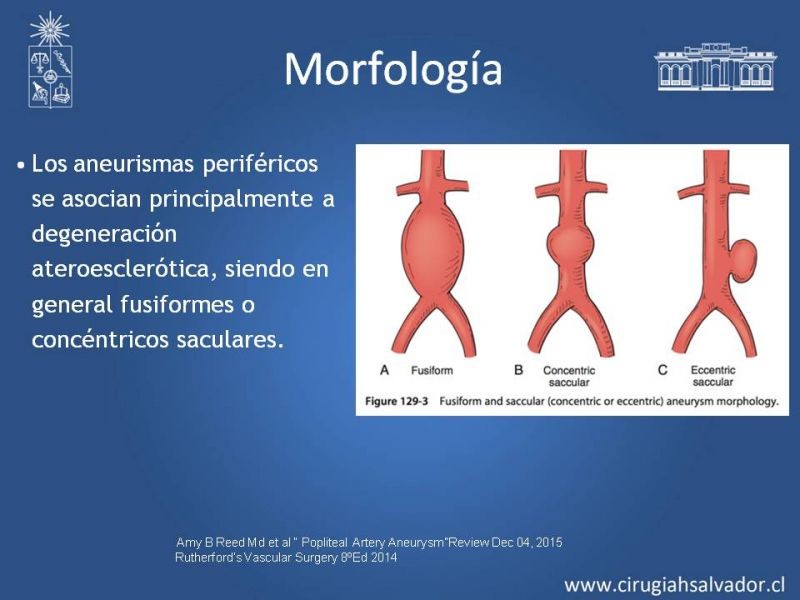 Diapositiva 12 de Aneurismas Periféricos