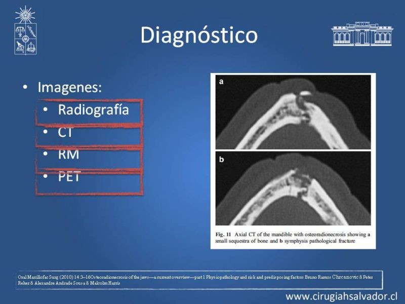 Diapositiva 10 de Osteoradionecrosis