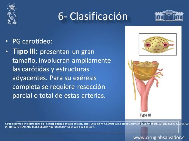 Diapositiva 20 de Paraganglioma cervical