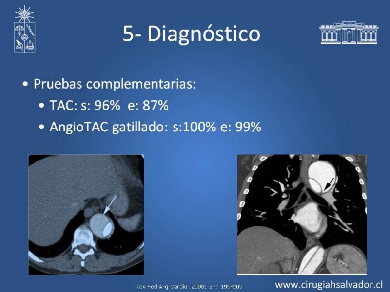 Diapositiva 26 de Síndrome Aórtico Agudo
