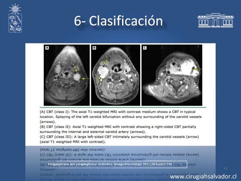 Diapositiva 21 de Paraganglioma cervical
