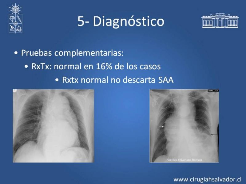 Diapositiva 25 de Síndrome Aórtico Agudo