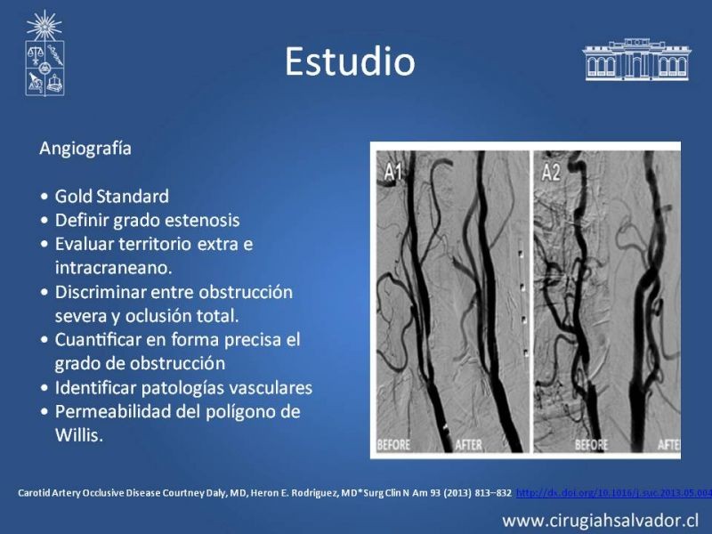 Diapositiva 17 de Estenosis Carotídea Asintomática