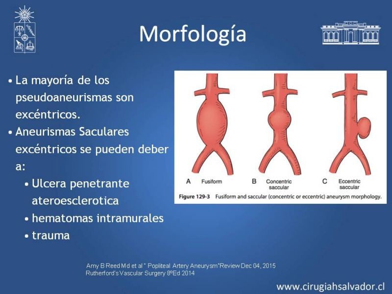 Diapositiva 13 de Aneurismas Periféricos