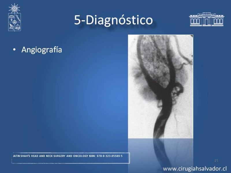 Diapositiva 14 de Paraganglioma cervical