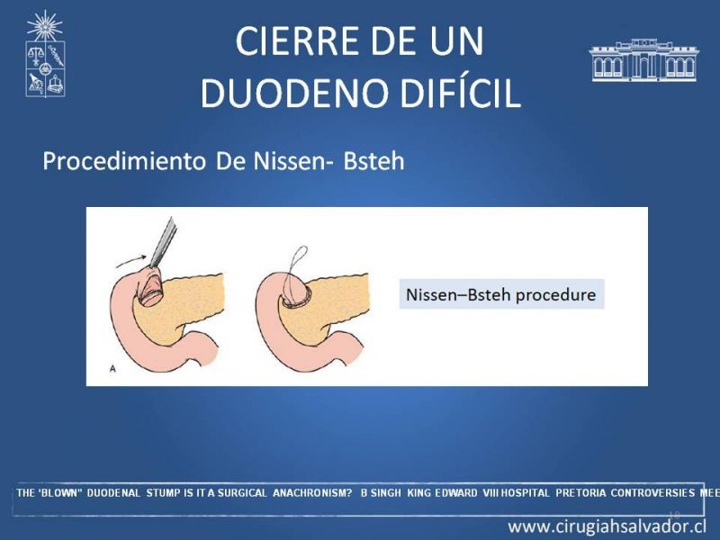 Diapositiva 17 de Manejo del muñón duodenal difícil
