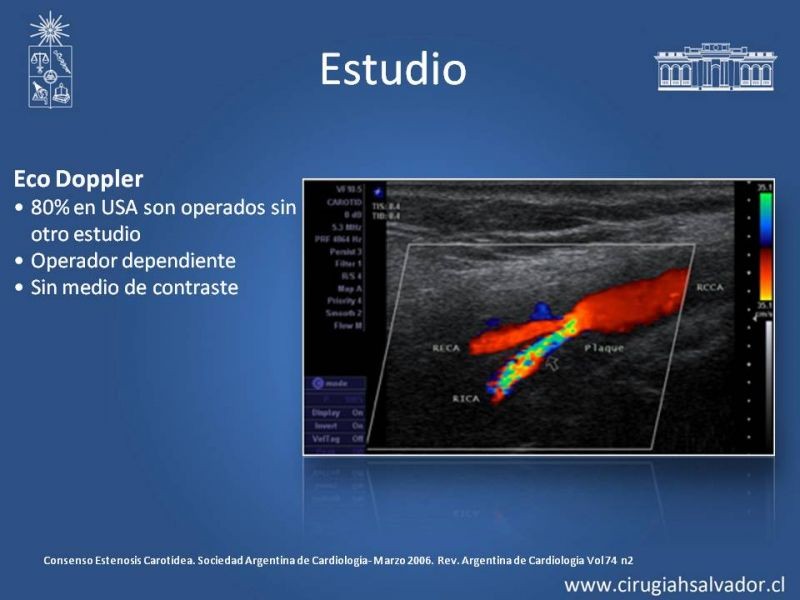 Diapositiva 13 de Estenosis Carotídea Asintomática