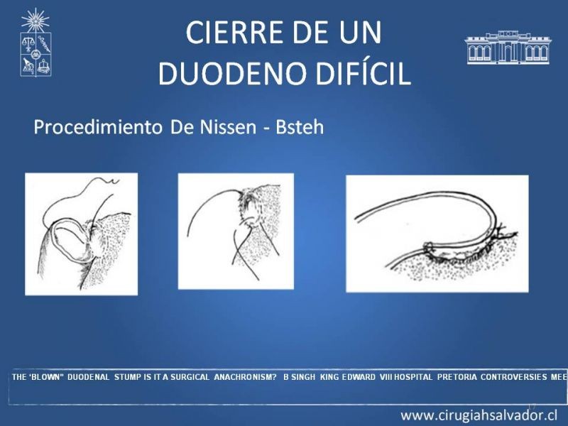 Diapositiva 16 de Manejo del muñón duodenal difícil
