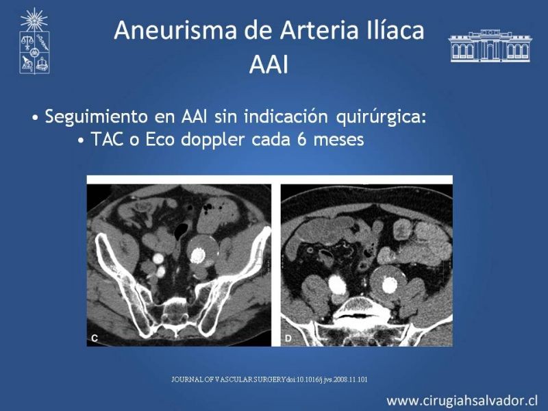 Diapositiva 20 de Aneurismas Periféricos