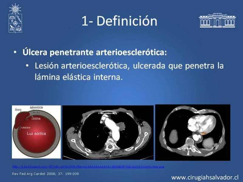 Diapositiva 7 de Síndrome Aórtico Agudo