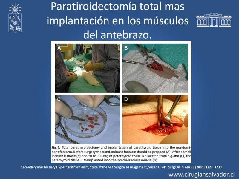 Diapositiva 18 de Hiperparatiroidismo secundario
