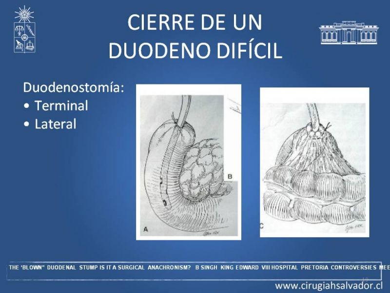 Diapositiva 18 de Manejo del muñón duodenal difícil