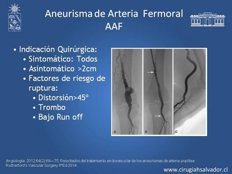 Diapositiva 29 de Aneurismas Periféricos