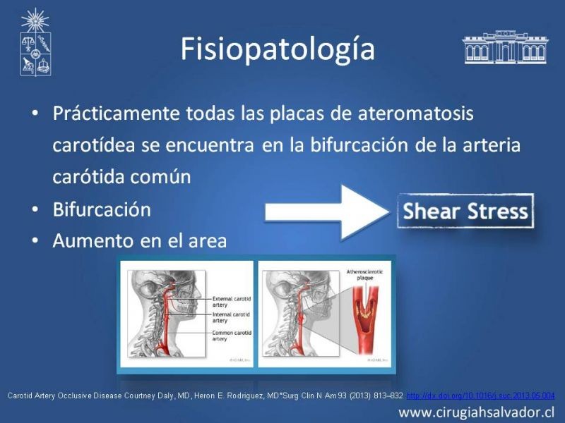 Diapositiva 6 de Estenosis Carotídea Asintomática