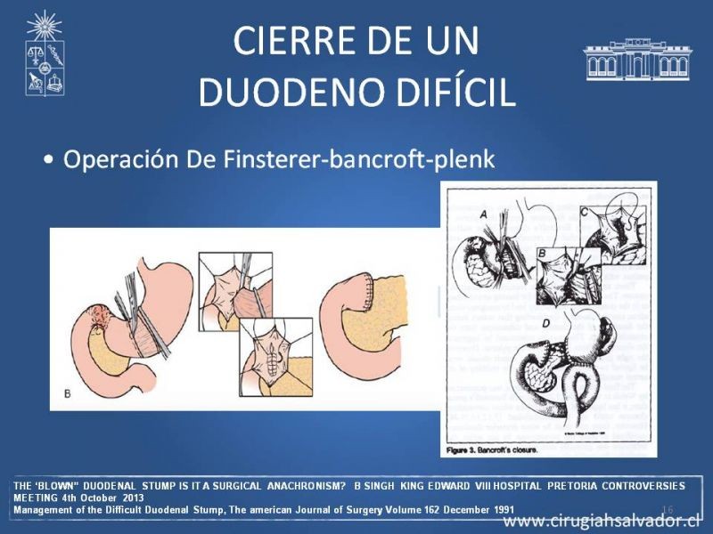 Diapositiva 15 de Manejo del muñón duodenal difícil
