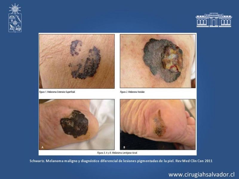 Diapositiva 15 de Manejo Quirúrgico del Melanoma 