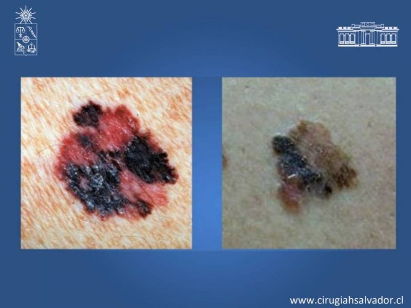 Diapositiva 14 de Manejo Quirúrgico del Melanoma 