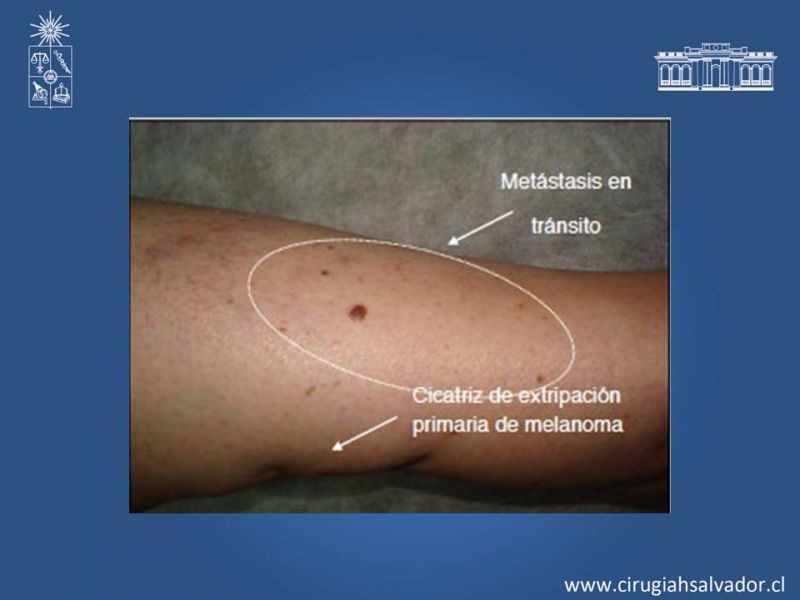 Diapositiva 37 de Manejo Quirúrgico del Melanoma 