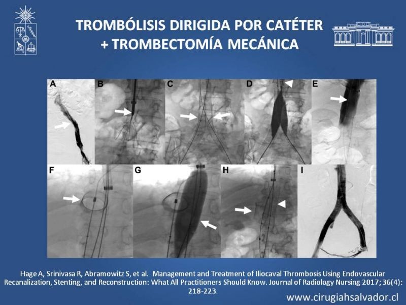 Diapositiva 24 de Indicación quirúrgica de la trombosis venosa profunda