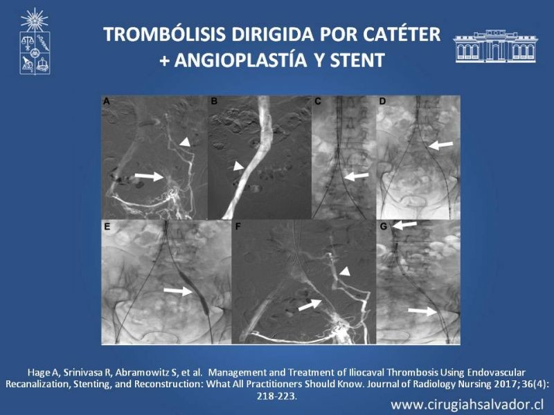 Diapositiva 23 de Indicación quirúrgica de la trombosis venosa profunda