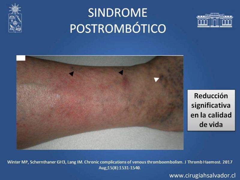 Diapositiva 10 de Indicación quirúrgica de la trombosis venosa profunda