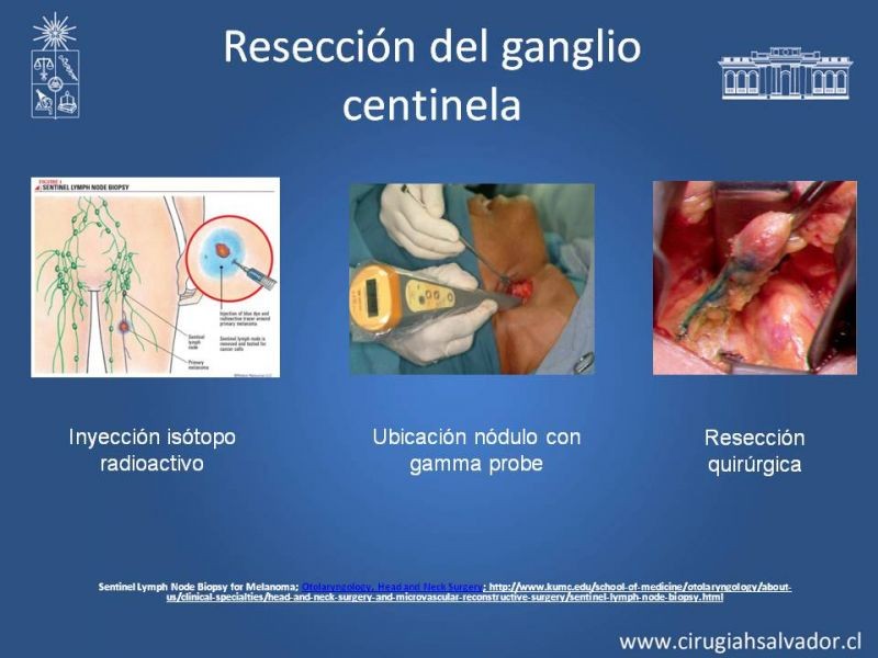 Diapositiva 17 de Ganglio centinela en Cáncer Espinocelular
