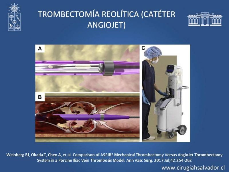 Diapositiva 26 de Indicación quirúrgica de la trombosis venosa profunda