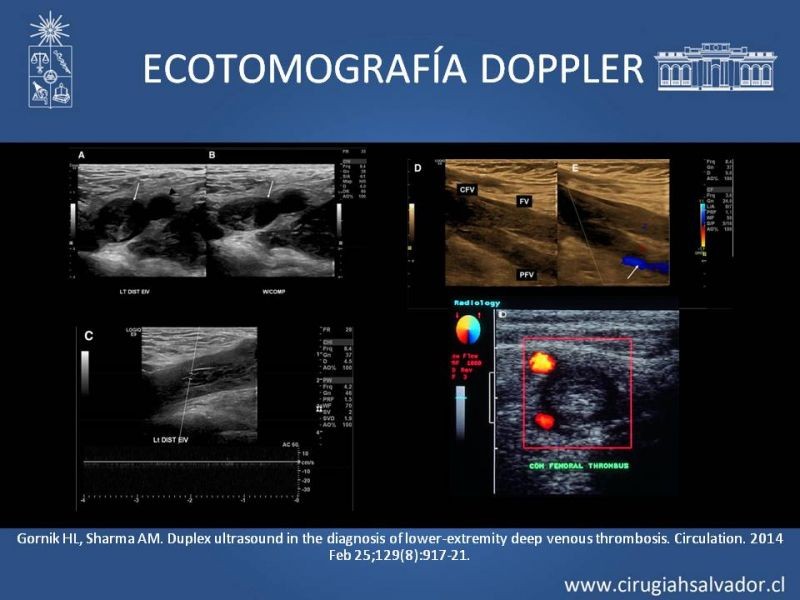 Diapositiva 3 de Indicación quirúrgica de la trombosis venosa profunda