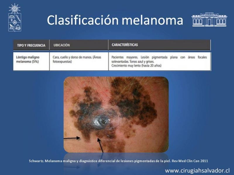 Diapositiva 11 de Manejo Quirúrgico del Melanoma 