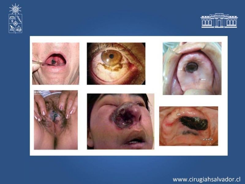 Diapositiva 16 de Manejo Quirúrgico del Melanoma 